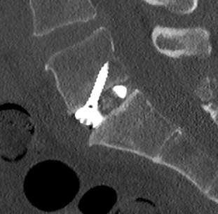 Xray showing ALIF procedure with placement of screw into vertebrae