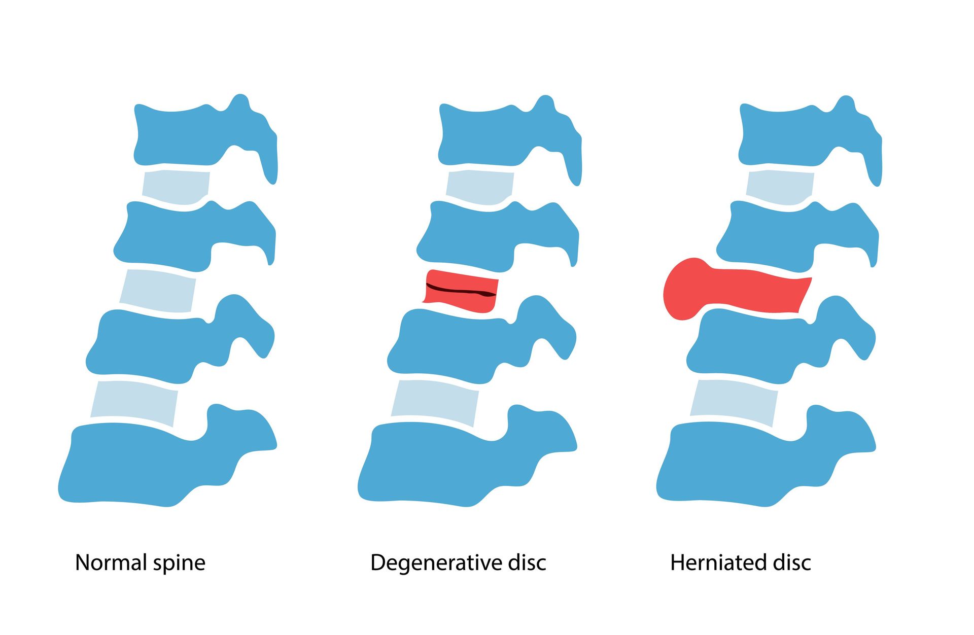 Degenerative Disc Disease Symptoms & Treatment