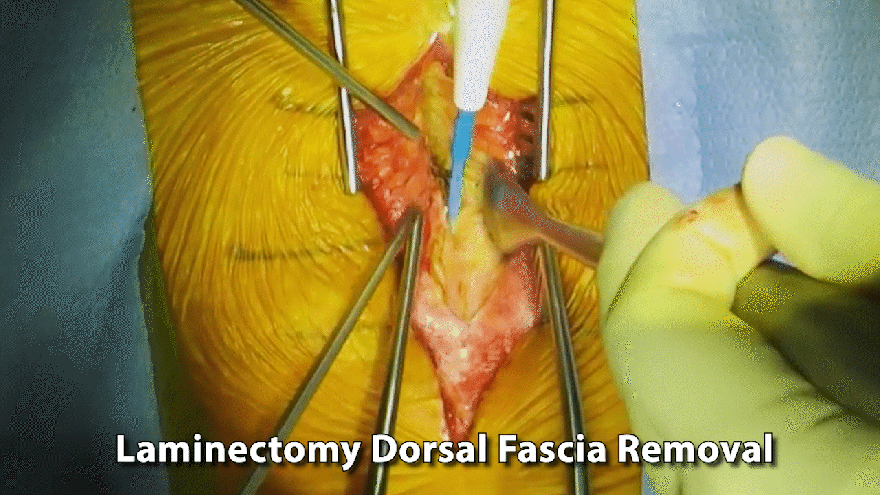 #2 Remove Dorsal Fascia GIF.gif