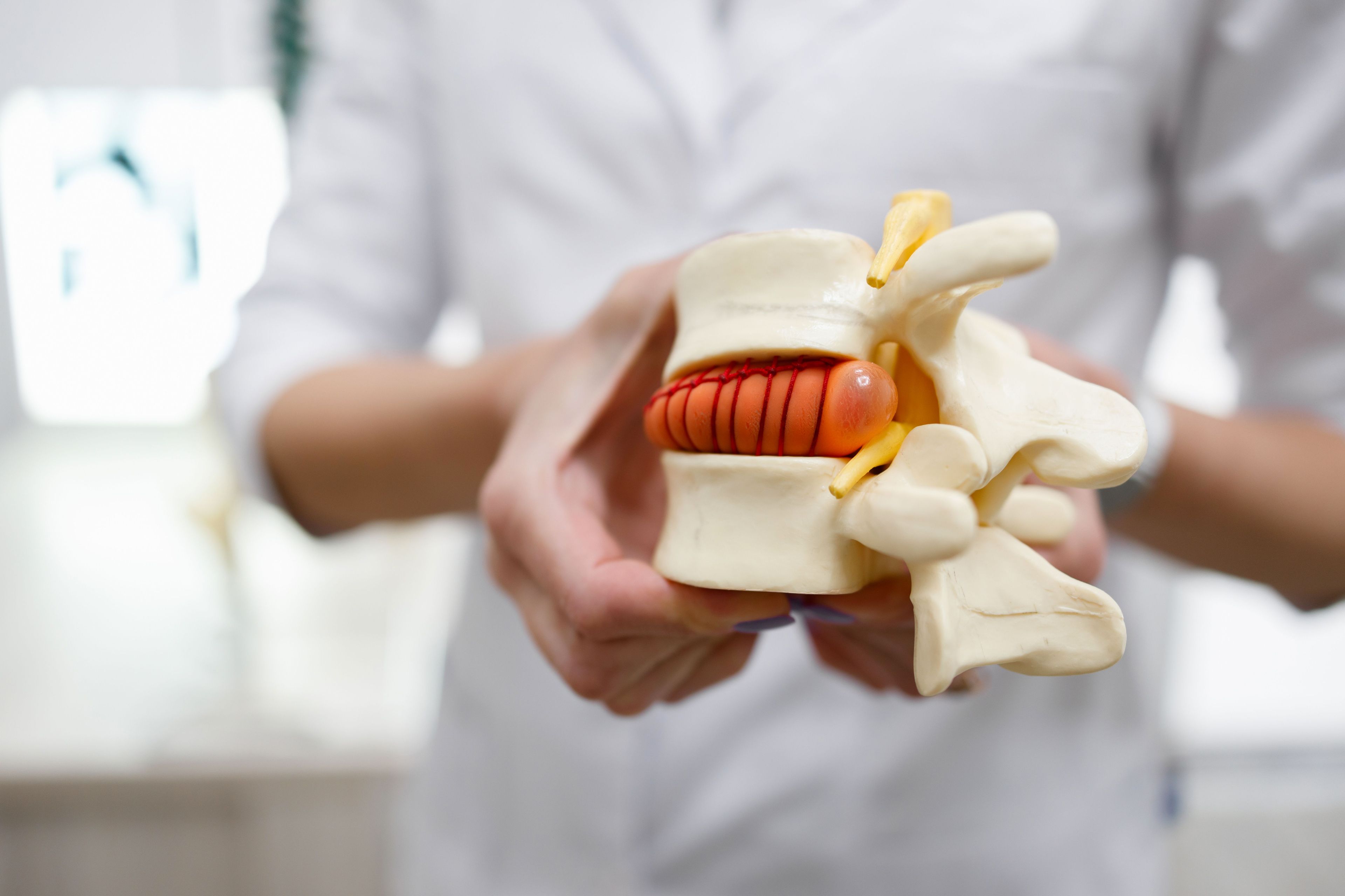A medical professional holding a spine model and pointing to a red, herniated disc bulging between two vertebrae