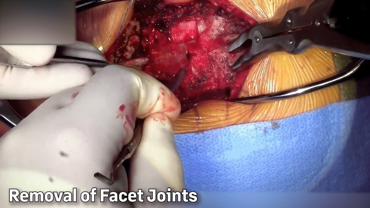 #6 Removal of Facet Joints GIF.gif