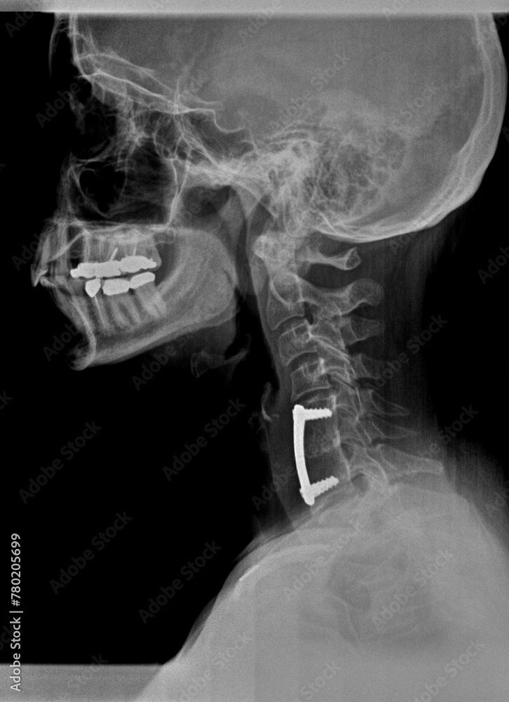ACC XRAy.jpeg