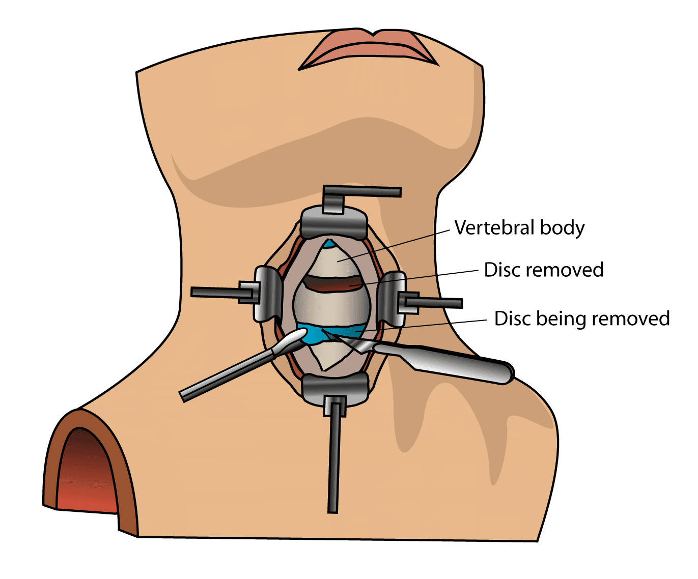 Illustration of how the cervical vertebrae is exposed during and ALIF surgery