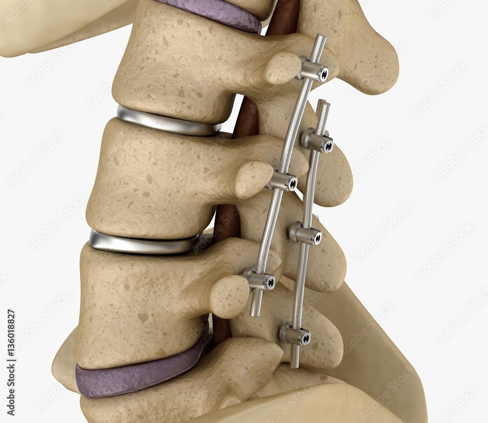Example of metal hardware used during a spinal fusion surgery