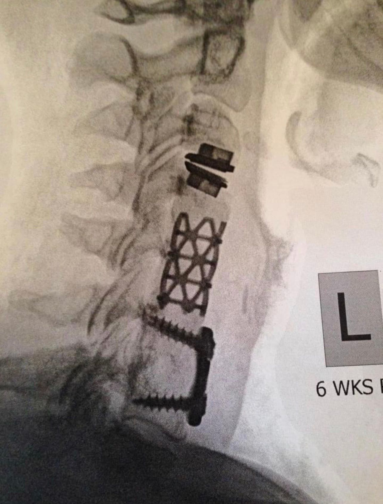 #Artificial Discs #Fusion #Adjacent Segment Disease #XRay #Lumbar #Complications-IMG_3045.jpg
