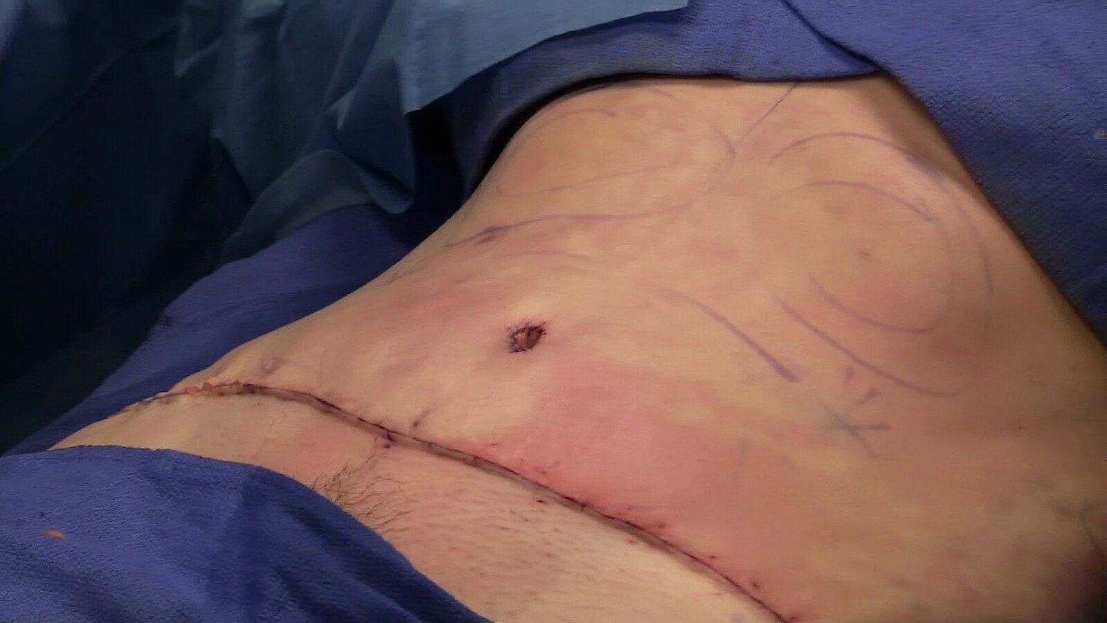 Back Surgery through abdomen (1).jpg