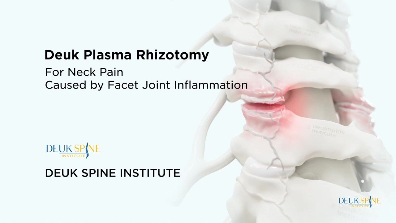 Thumbnail for the Cervical Deuk Plasma Rhizotomy video.