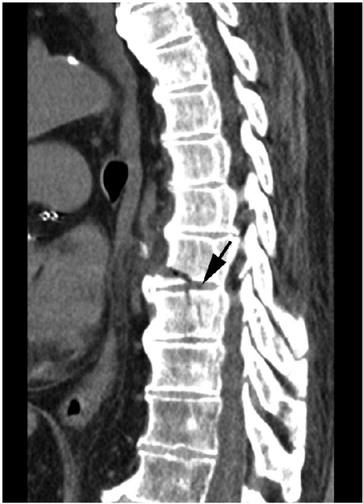 MRI image of a cervical endplate fracture