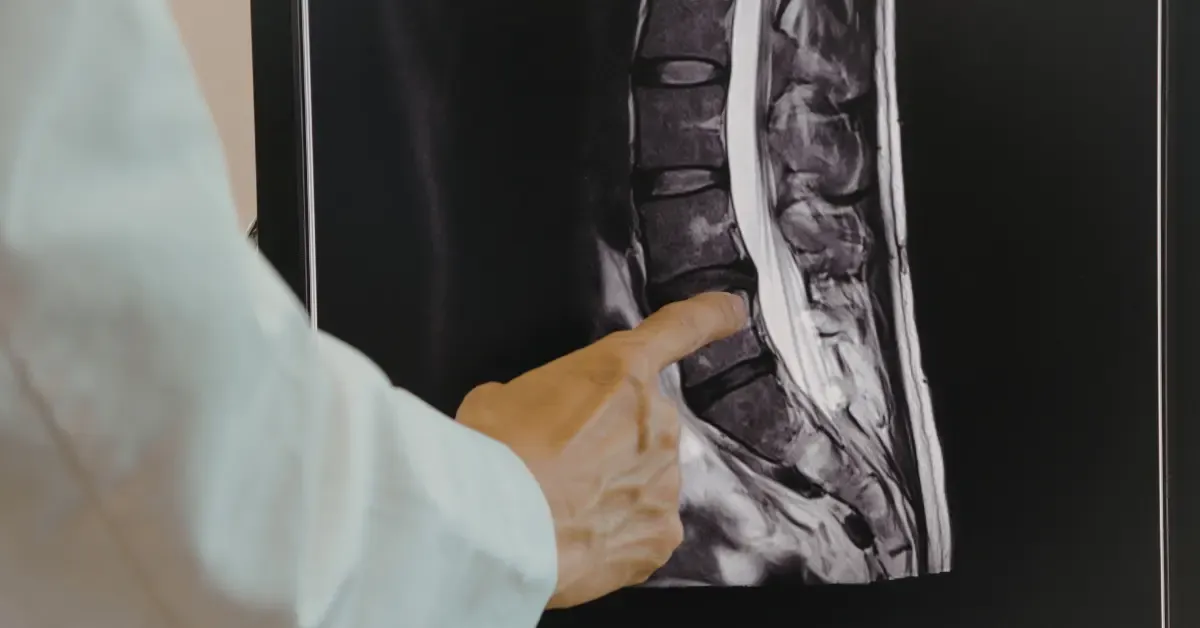A doctor pointing to a lumbar spine MRI scan to assess spinal conditions and determine candidacy for spinal fusion surgery