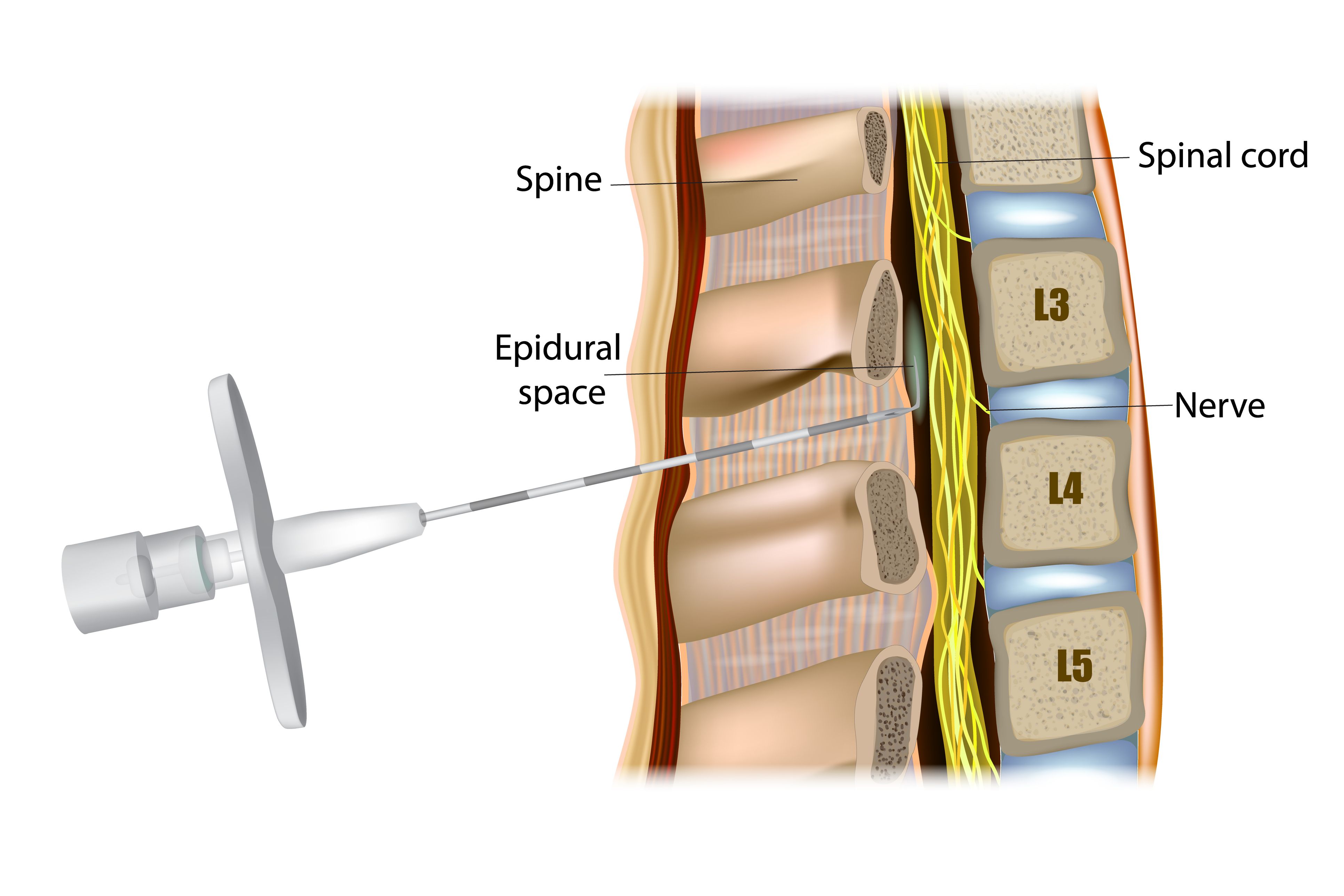 Illustration of an epidural injection into the spine