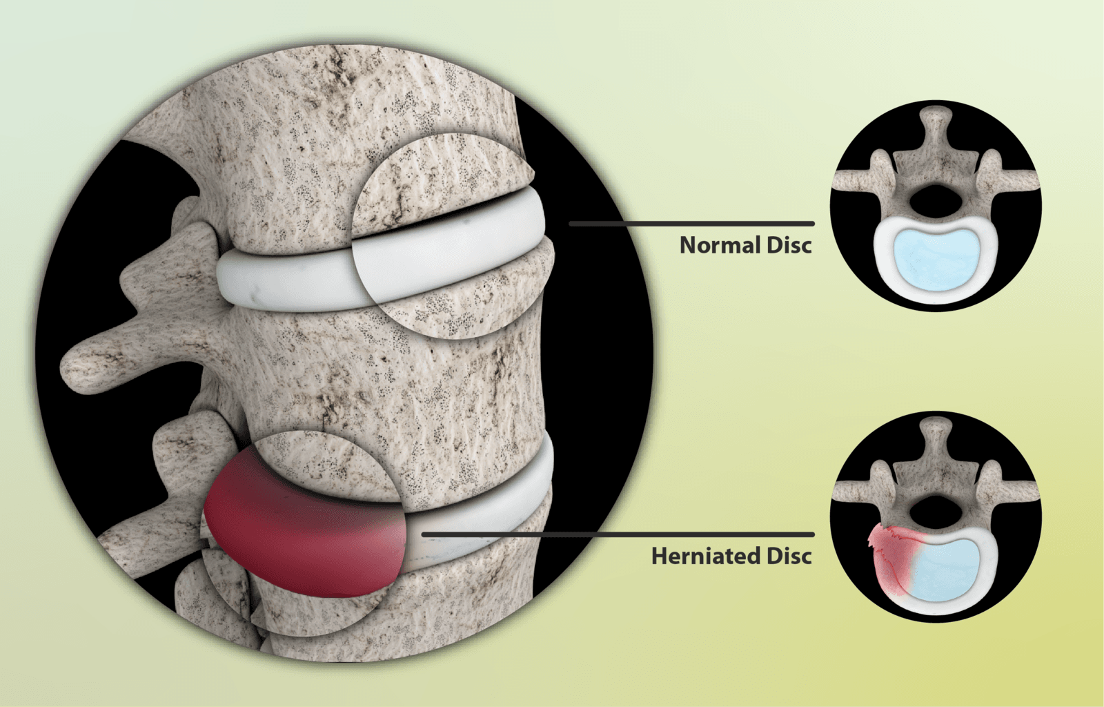 A view of a herniated disc at L-4-L5