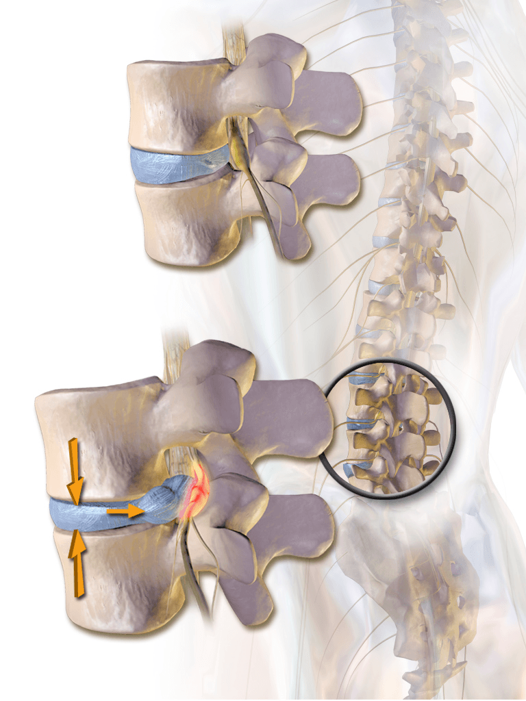 Image of a herniated disc
