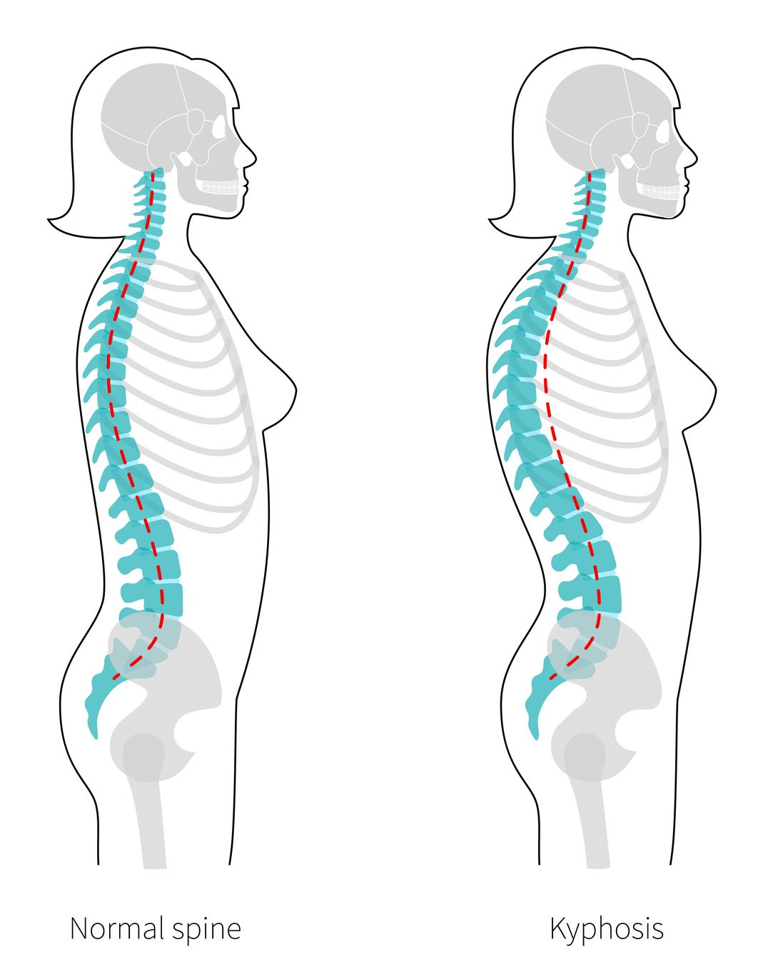 Illustrated example of Kyphosis