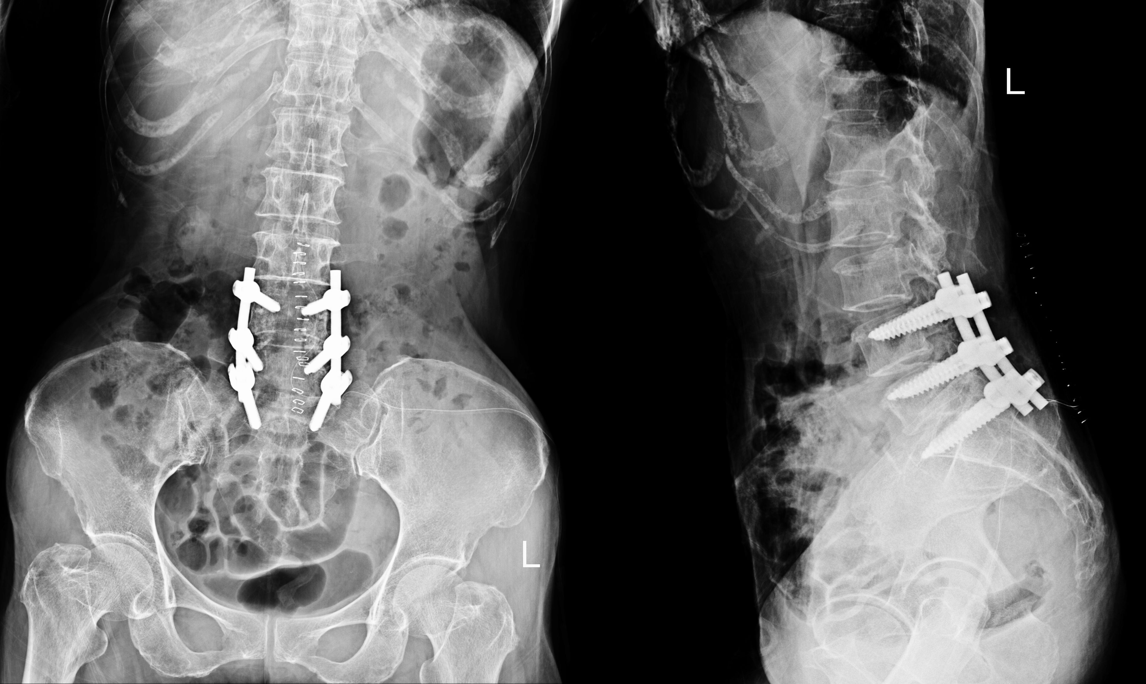 X-ray of lumbar fusion