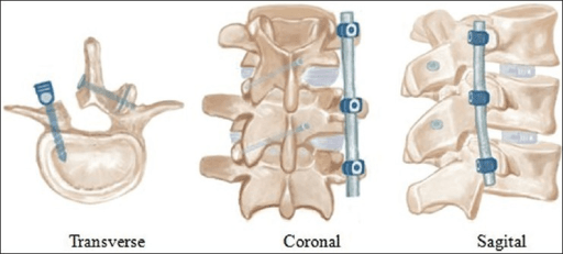 Illustrations of rods and screws implanted in vertebrae during PLIF surgery