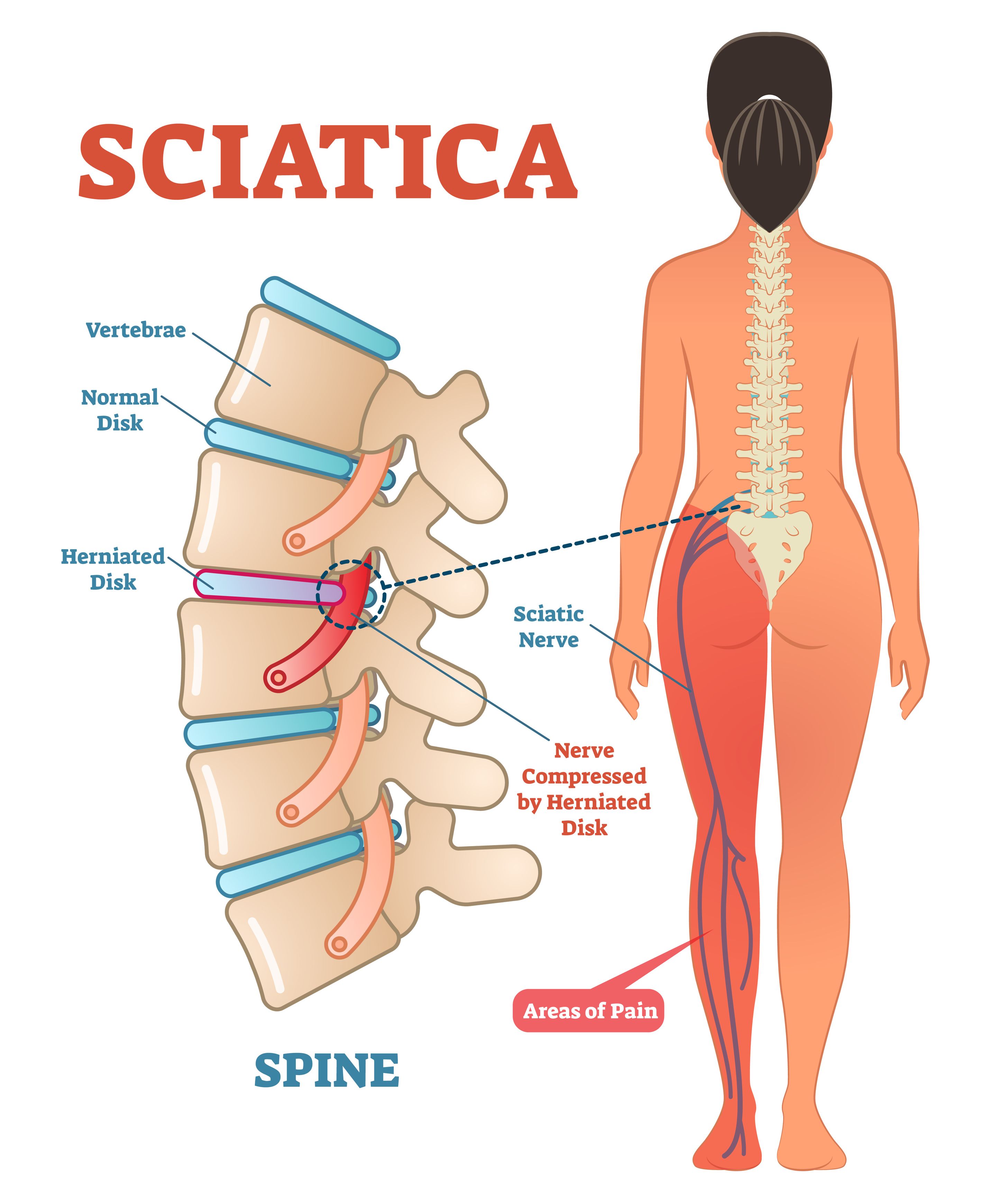 Sciatica.jpg