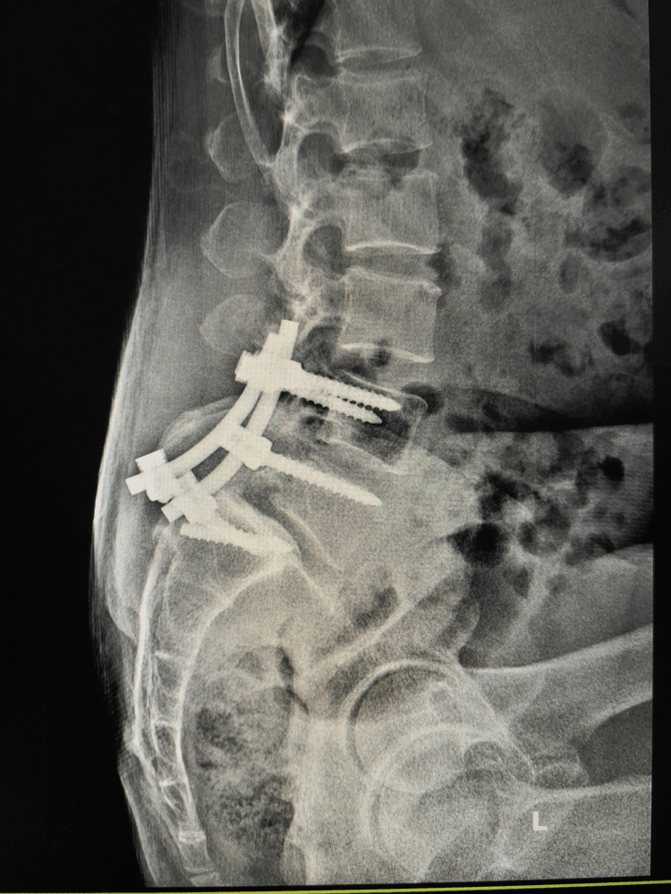 Example of metal hardware placed in body during spinal fusion