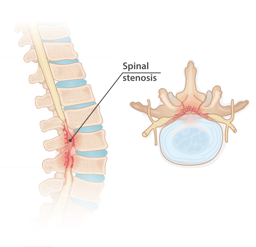 image of spinal stenosis