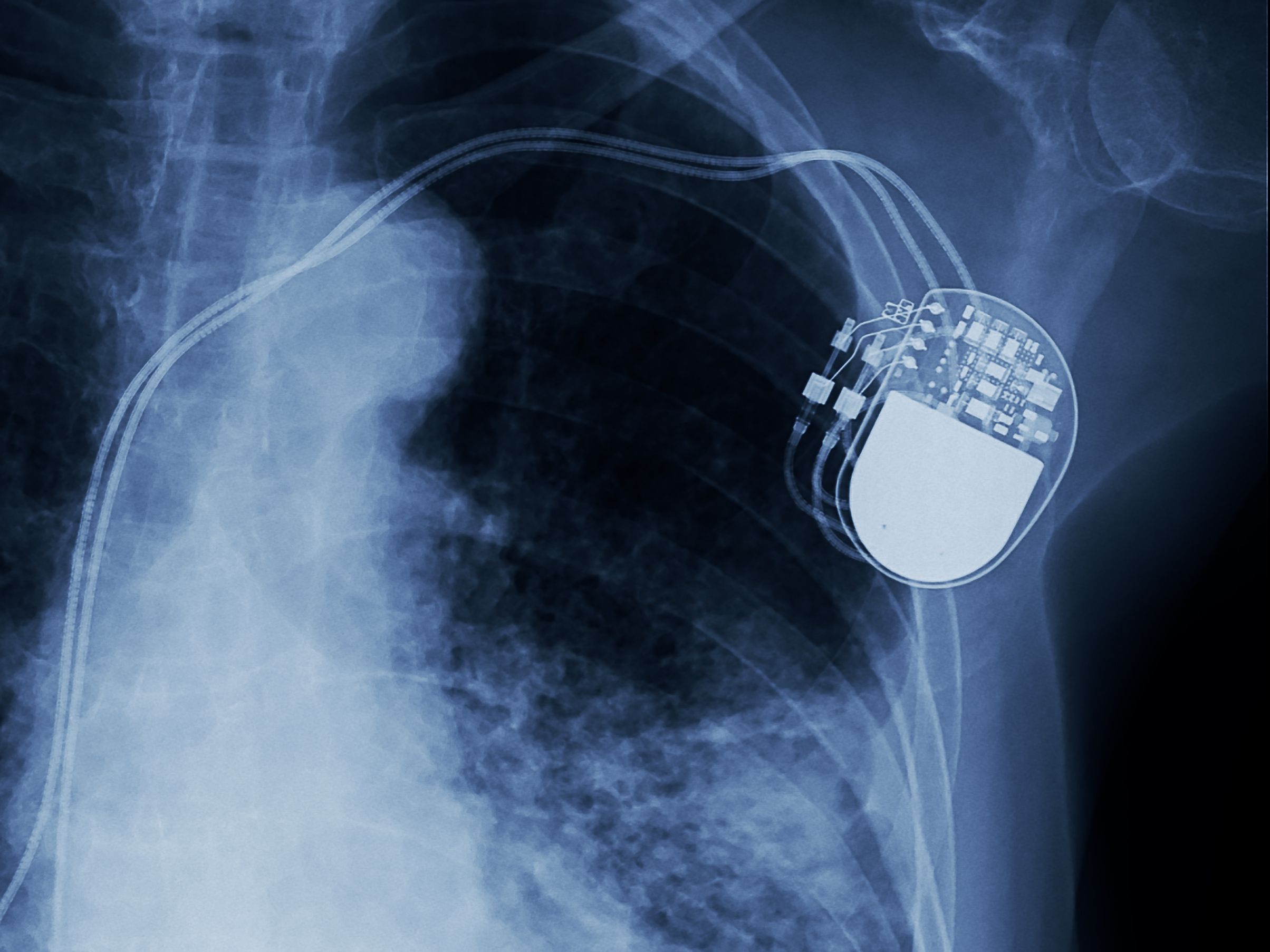 Xray of spinal cord stimulator implanted