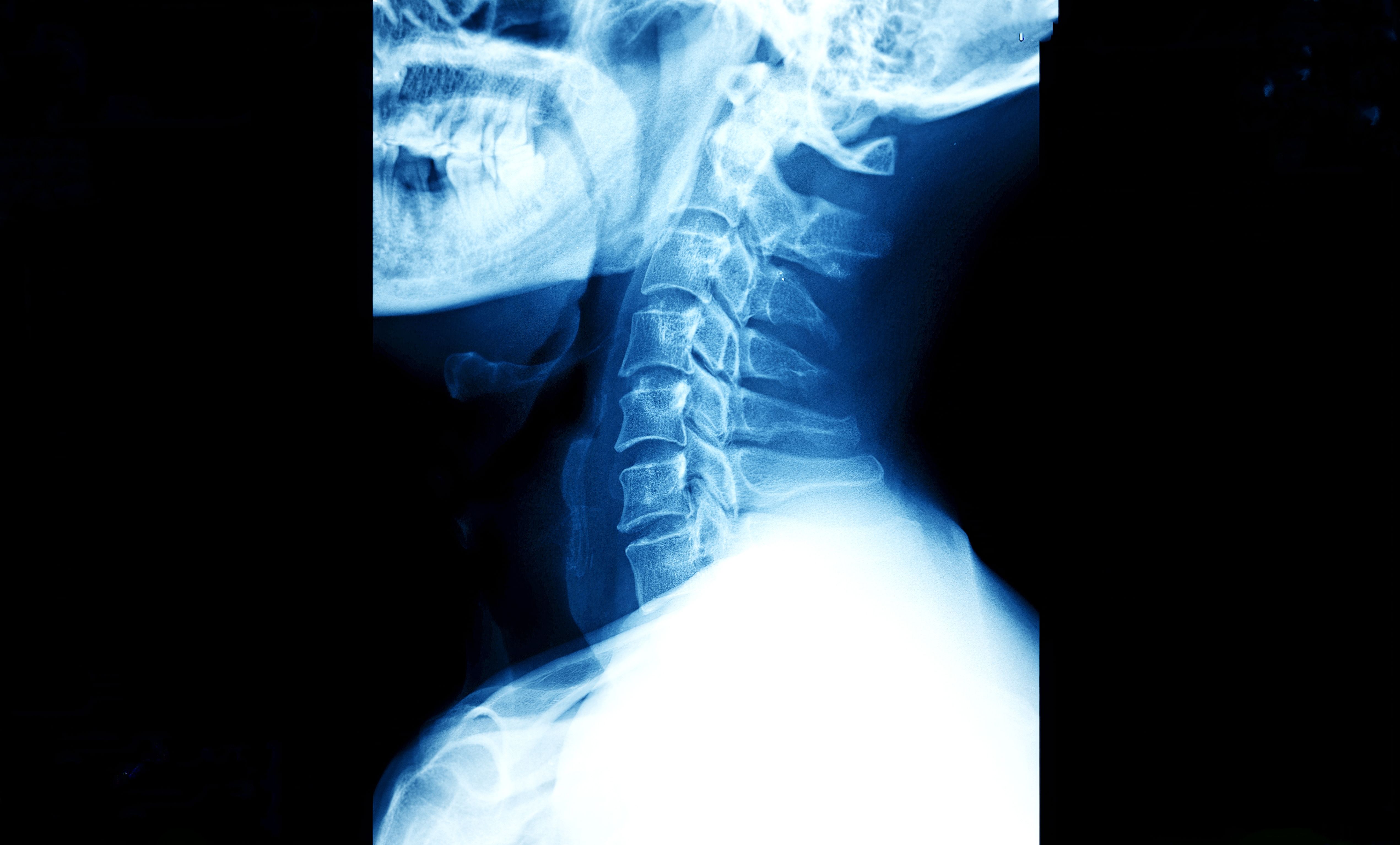 X-ray image of neck