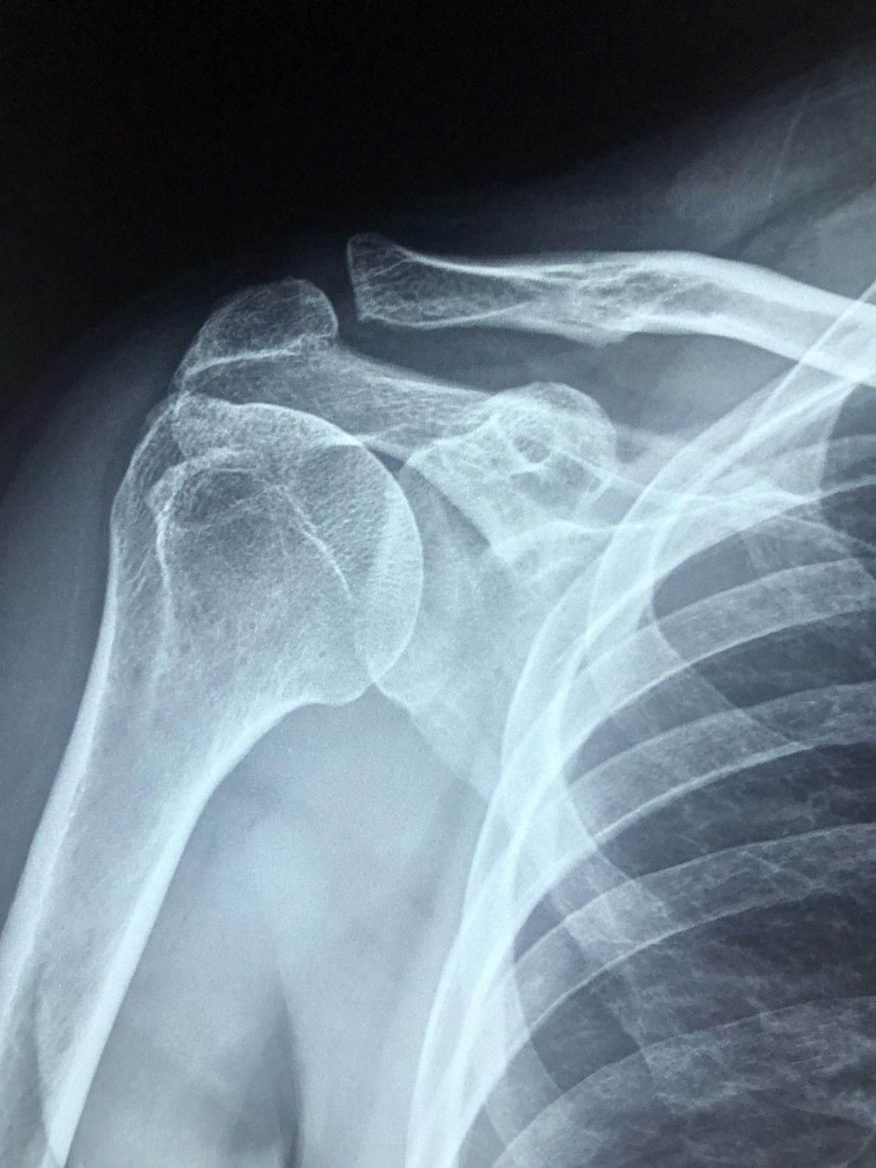 x-ray style image of human shoulder
